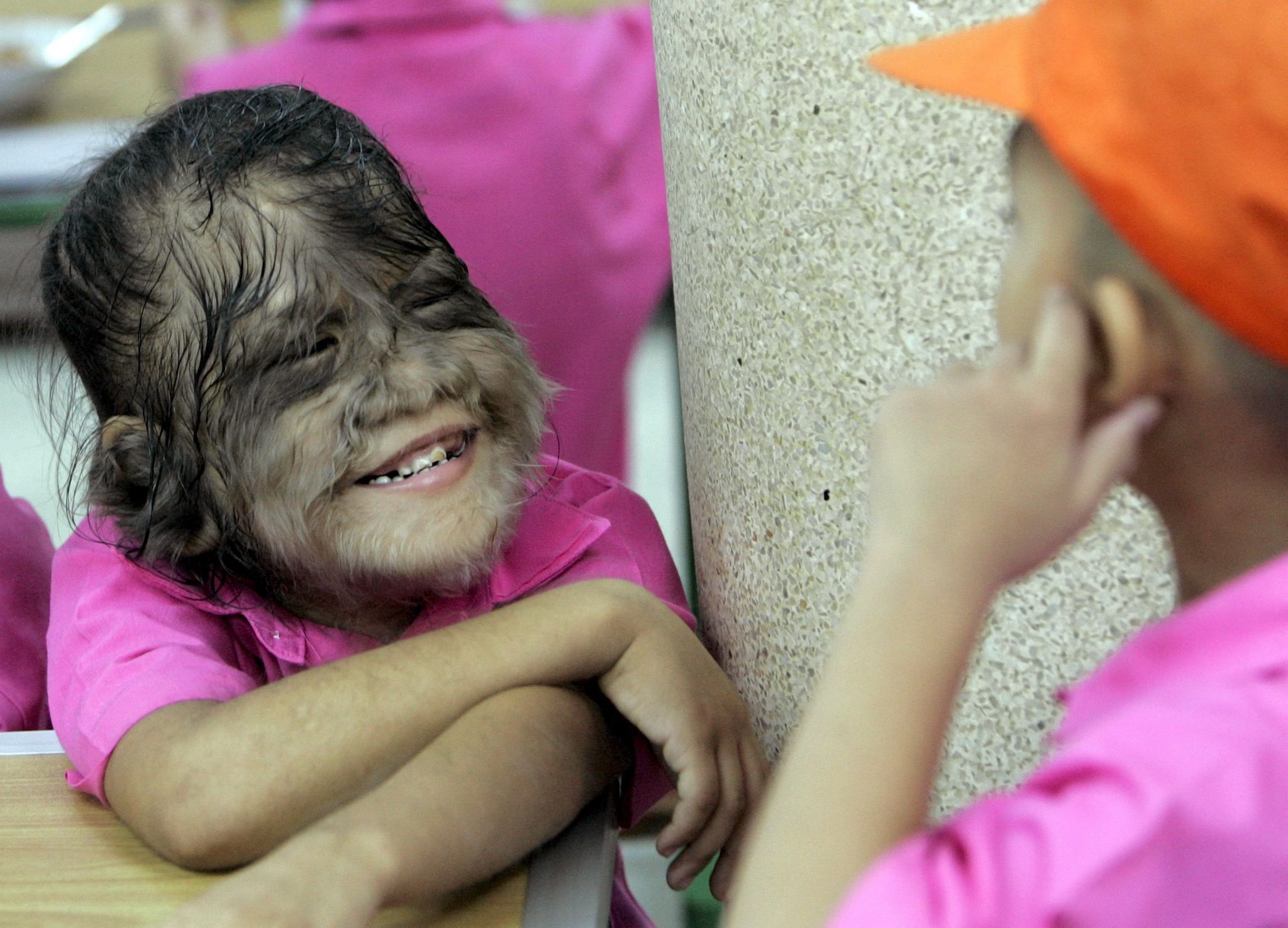 A child suffering from Hypertrichosis