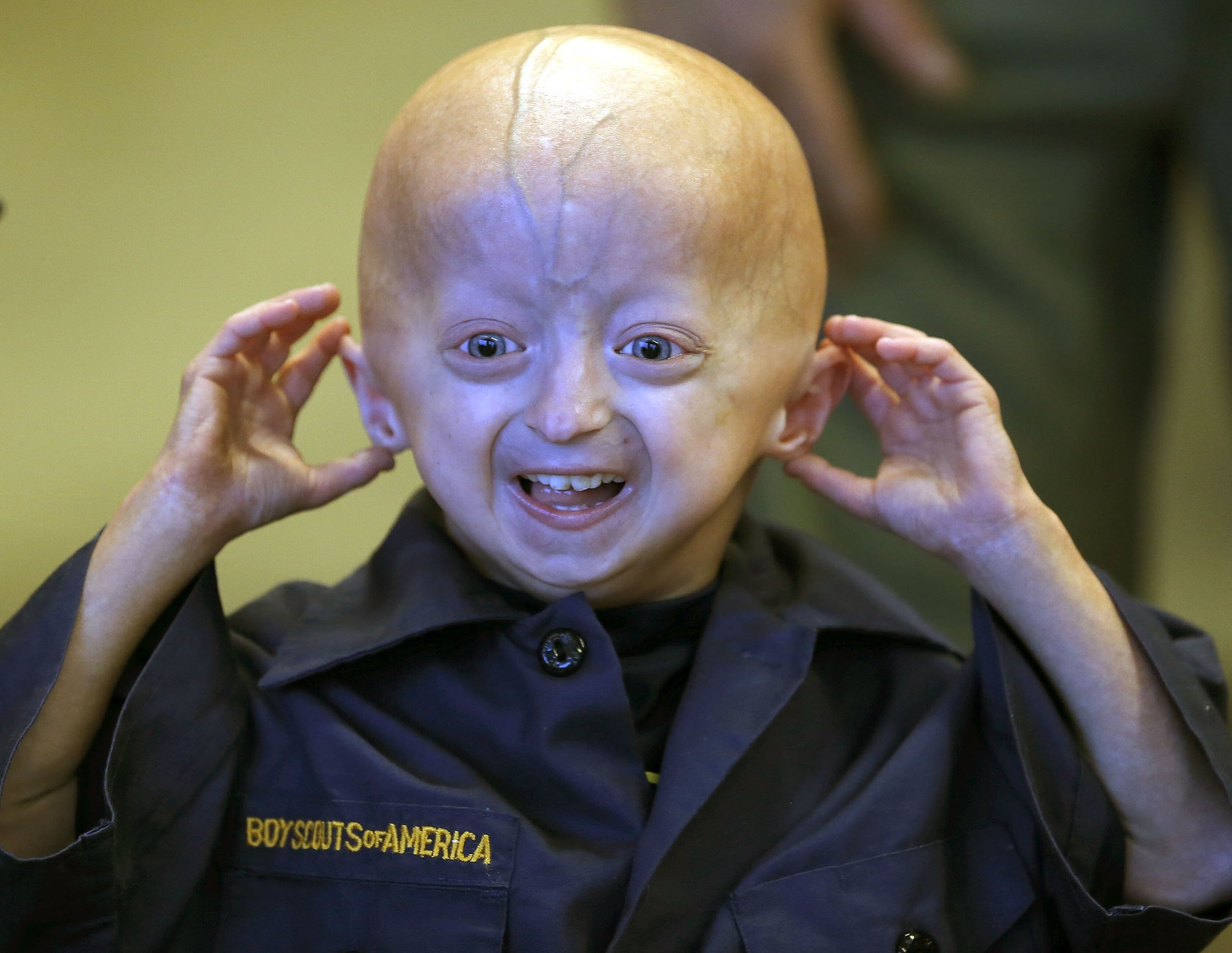 Zach, 6, is one of fewer than 250 people worldwide with the rapid-aging disease progeria | Photo credit: Charles Bertram